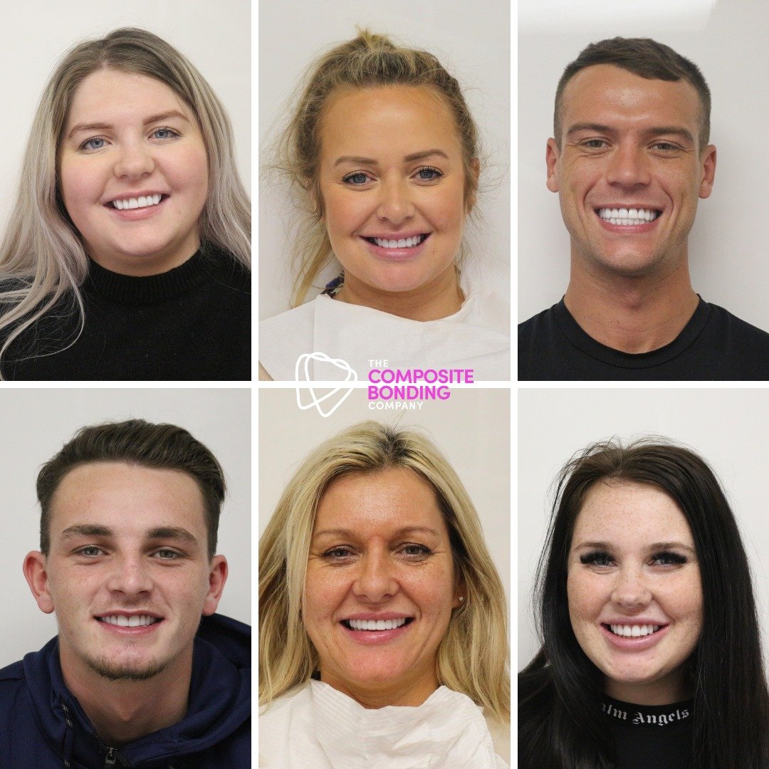 Book your Consultation for £35 Composite Bonding Oldham manchester