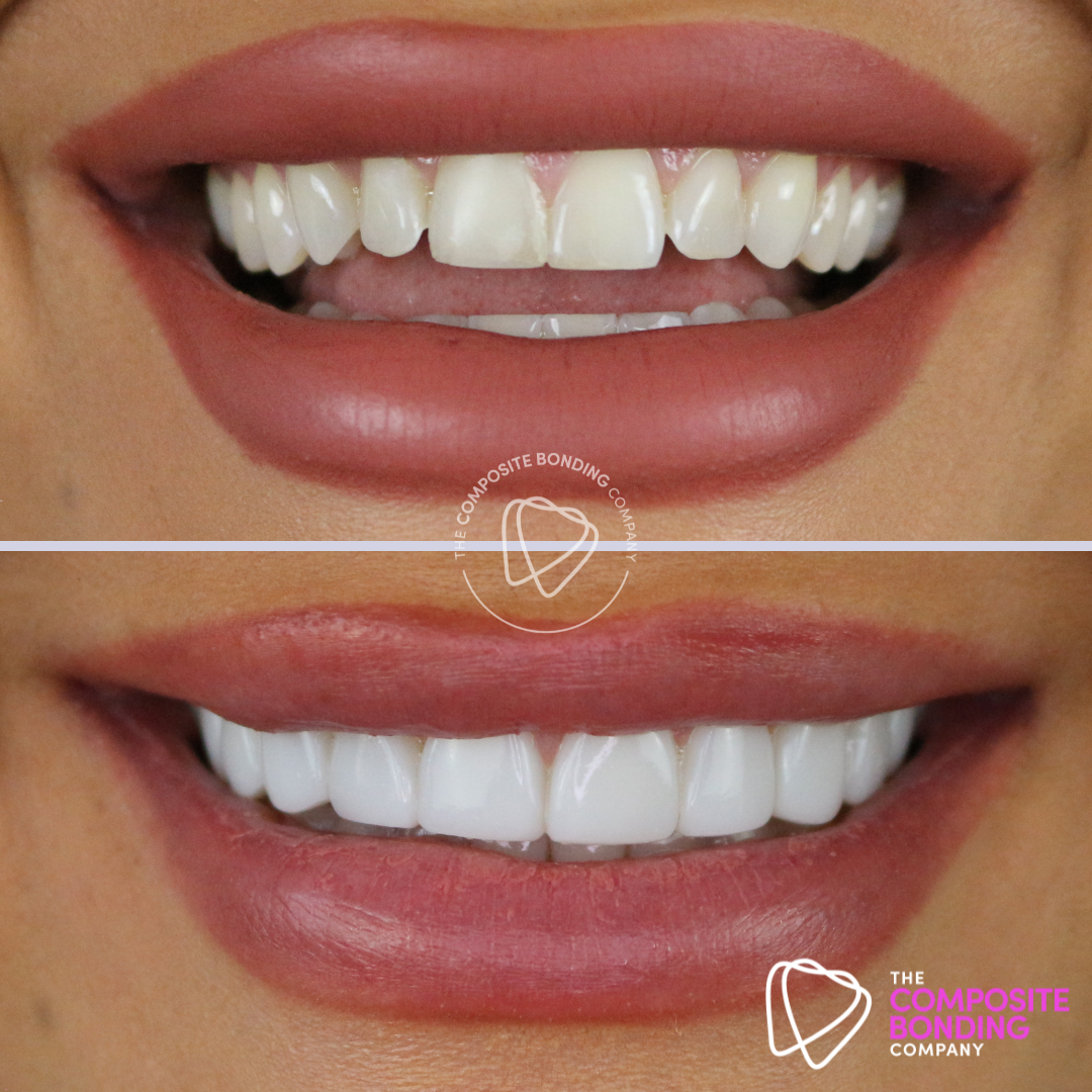 Book your Consultation for £35 Composite Bonding Oldham manchester