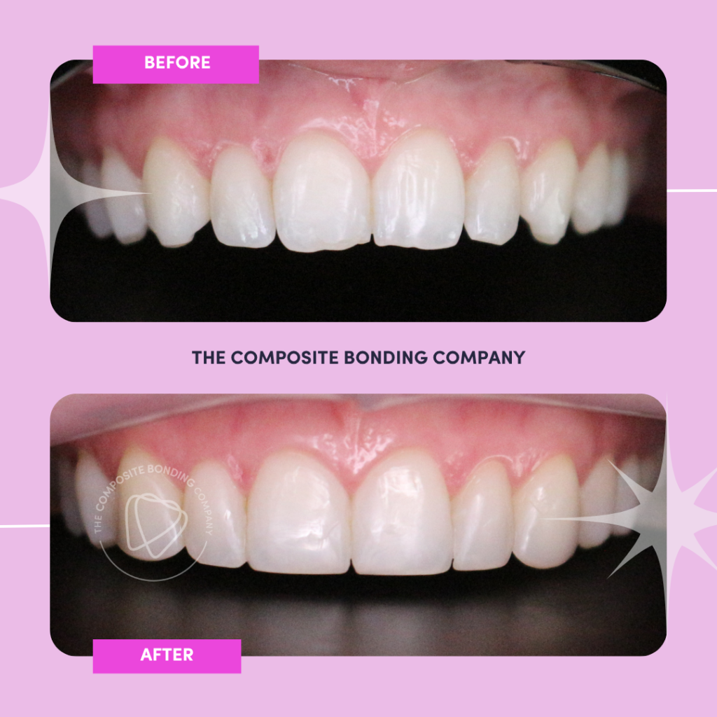 The Composite Bonding Company in Oldham | Natural-Looking Smile Improvements