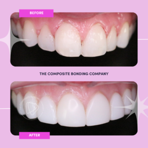 The Composite Bonding Company - Smile Transformation